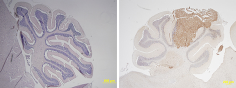 Coupe de cervelet normal (&agrave; gauche) et envahi par un m&eacute;dulloblastome (&agrave; droite). Le m&eacute;dulloblastome exprime des g&egrave;nes normalement uniquement actifs dans la r&eacute;tine, dont NRL et CRX, qui jouent un r&ocirc;le dans la formation de la tumeur.